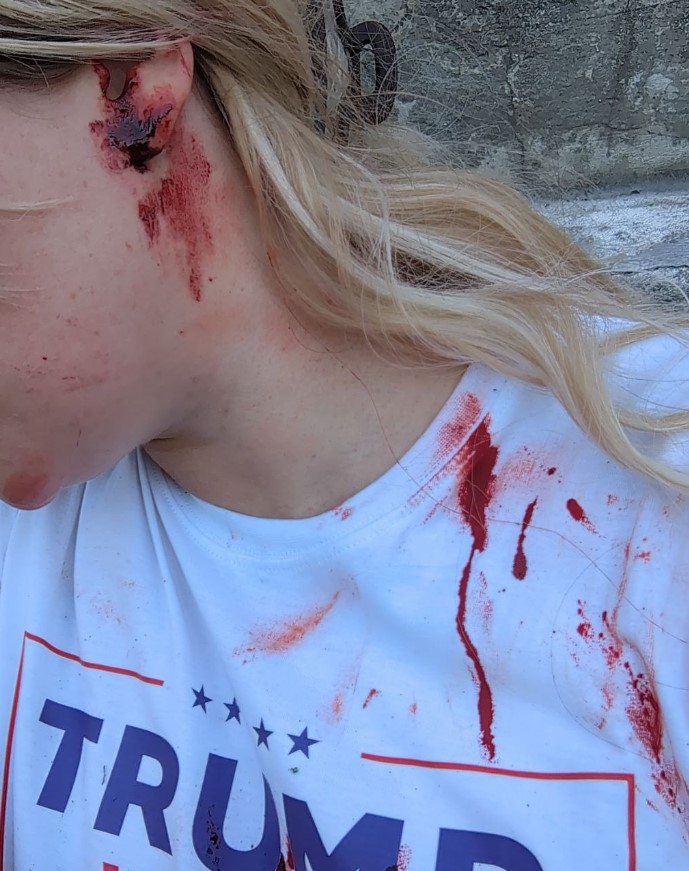 Injuries suffered by a female Trump supporter